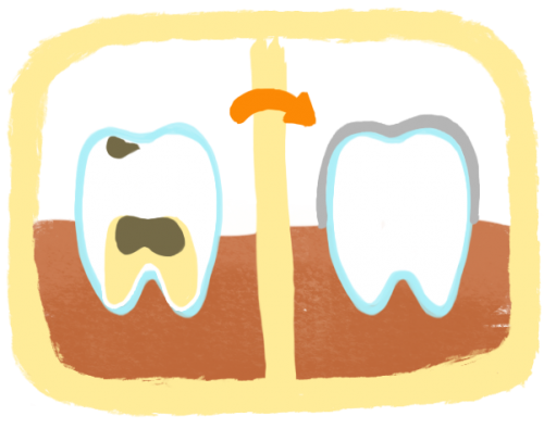 根管治療與乳牙不鏽鋼牙冠